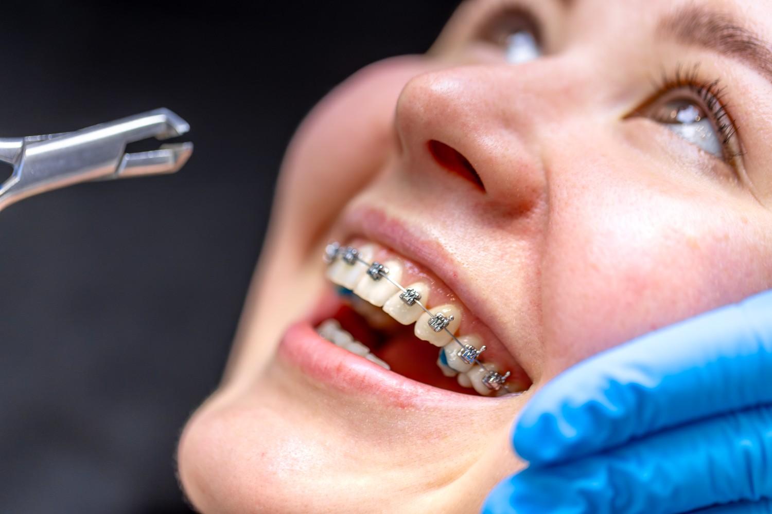 Can Braces Fix Gaps Between Teeth Permanently
